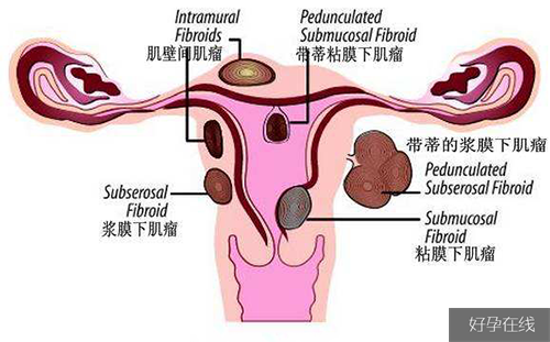 子宫肌瘤试管婴儿饮食禁忌