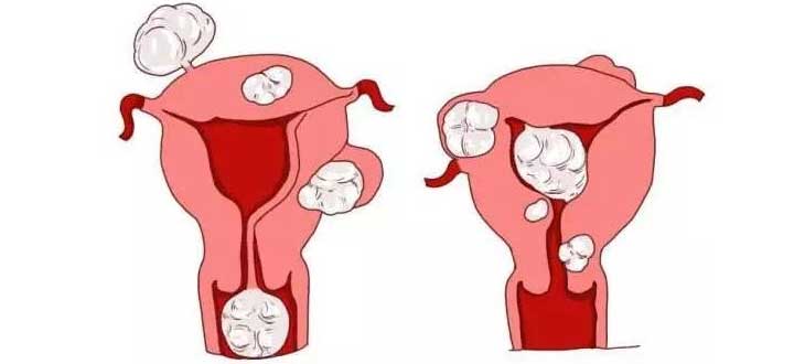 大部分子宫子宫肌瘤不影响试管婴儿