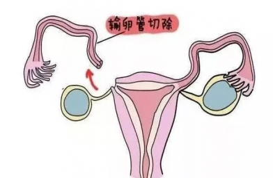 天津慈铭博鳌国际医院三代试管婴儿，切除双侧输卵管还能做试管婴儿吗？